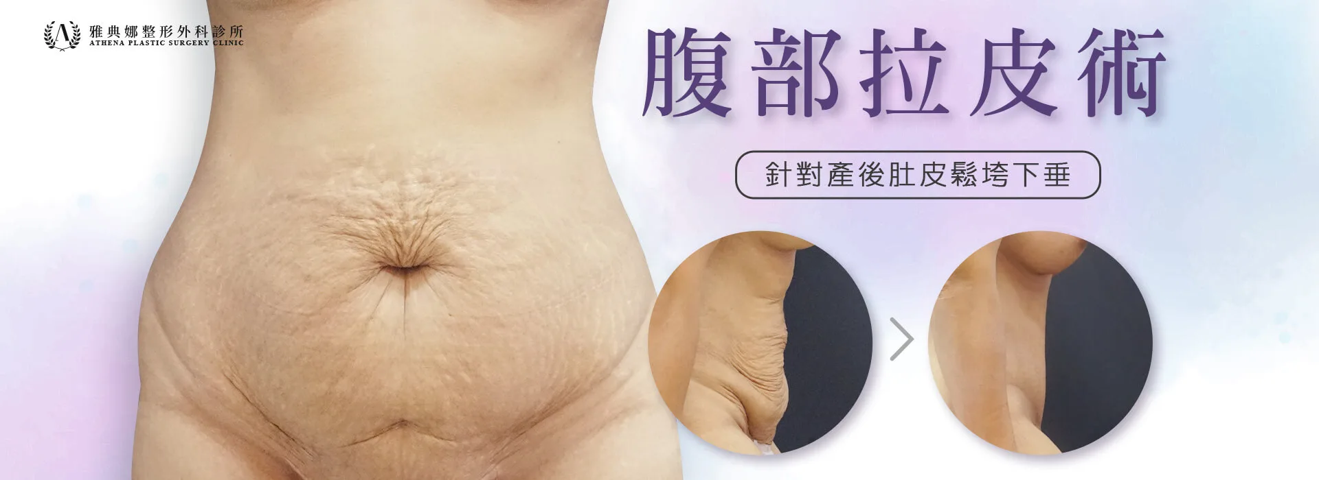 腹部拉皮