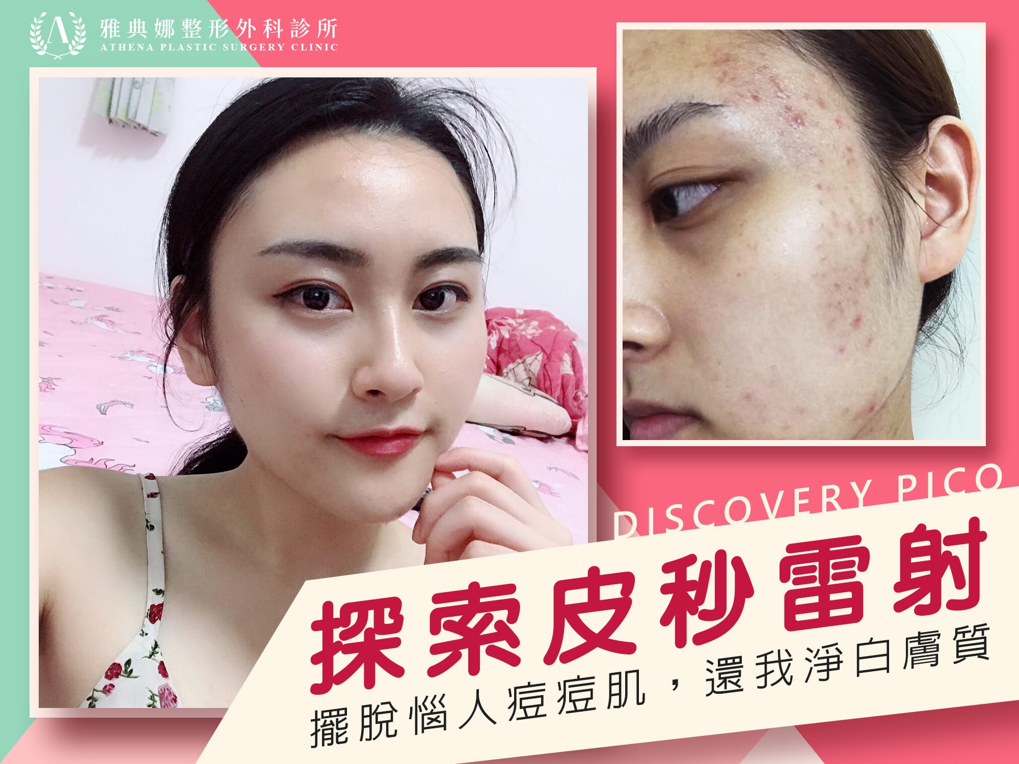 【本院實例】探索皮秒雷射
