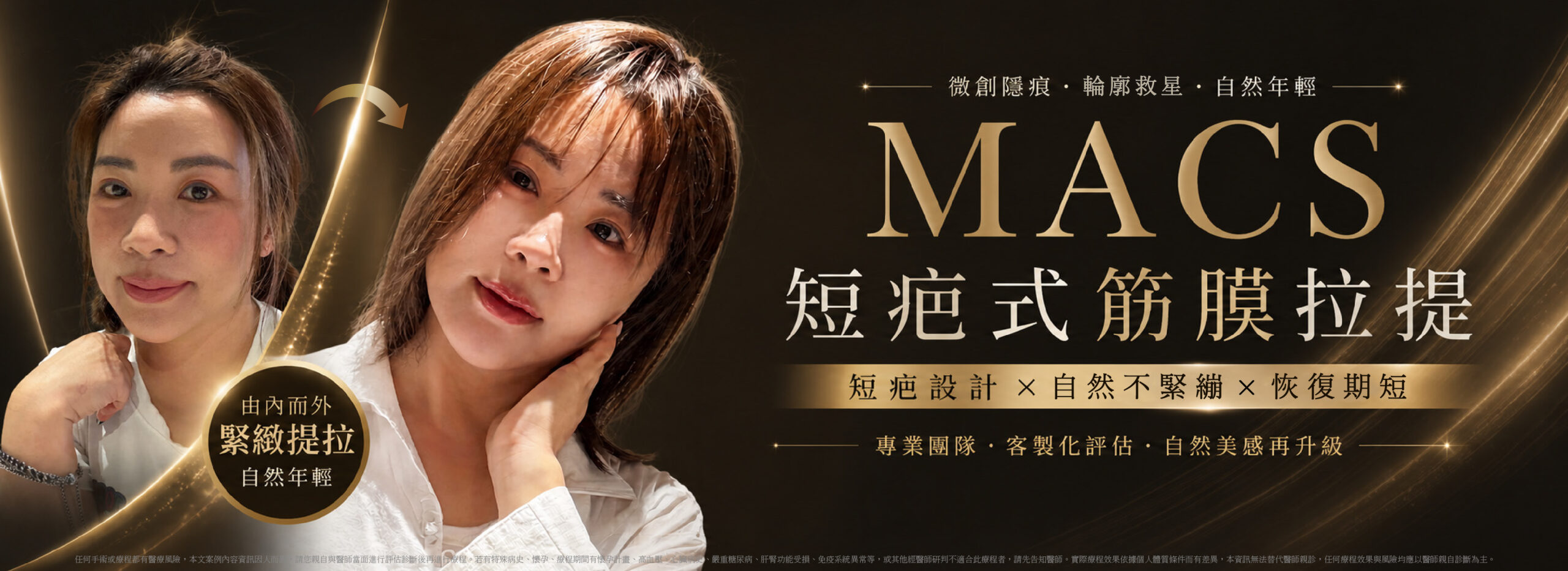 短疤式筋膜拉提